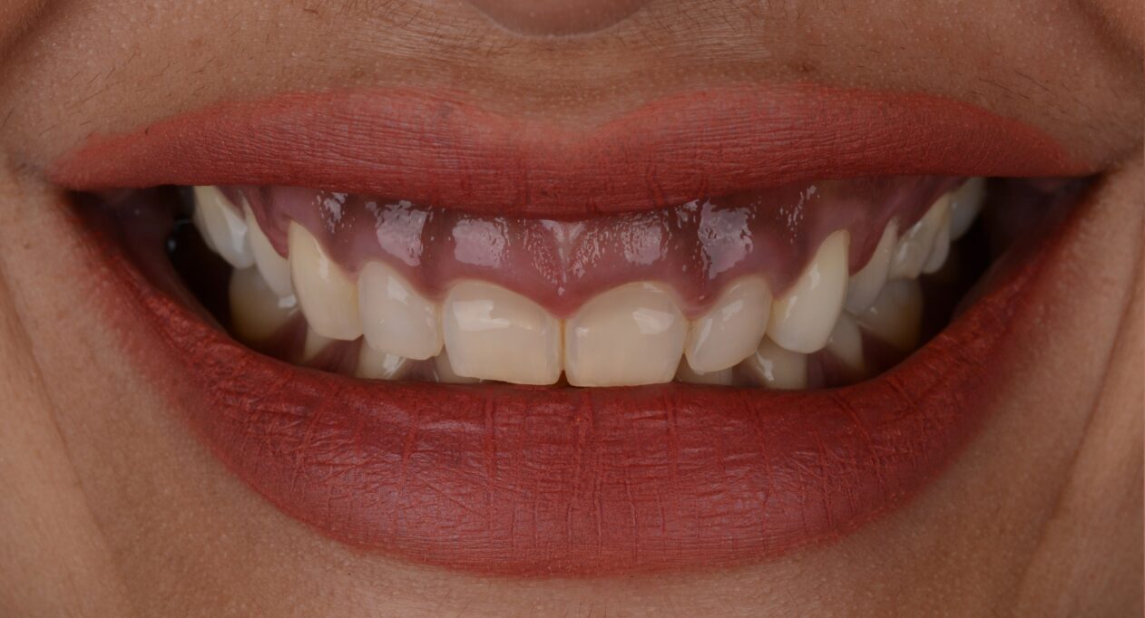 Cosmetic crown lengthening to correct gummy smile