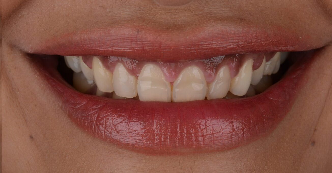 Cosmetic dentistry, crown lengthening improving gummy smile