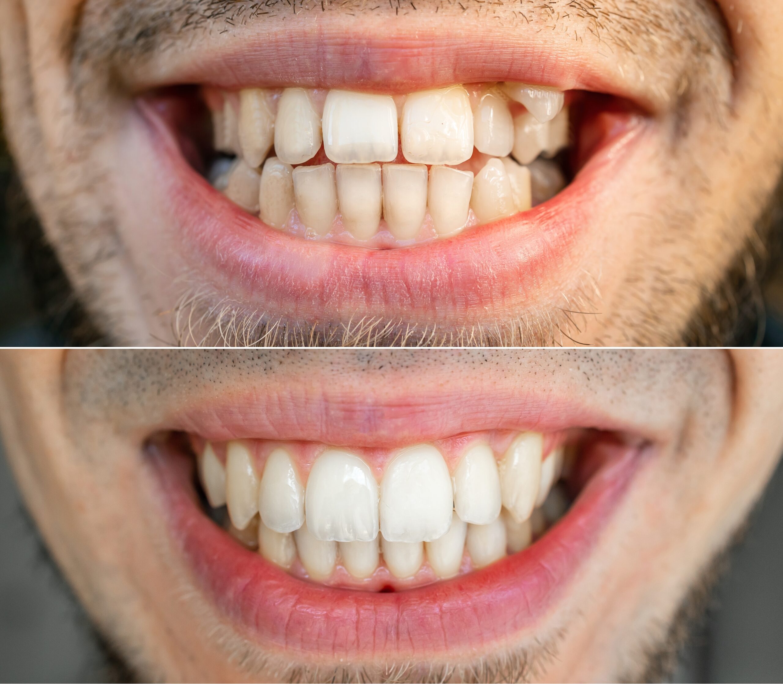 Wonderful smile transformation with clear aligners. Our dentist in Carson, Dr. Tran, is passionate about braces and aligners and is here to help you to achieve similar transformation.