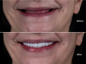 All on X implants help this patient to chew and smile again.