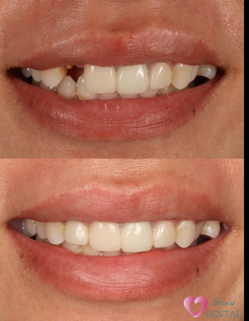 Immediate dental implant placement in Carson, CA for a broken front tooth. Patient can smile again with confidence.