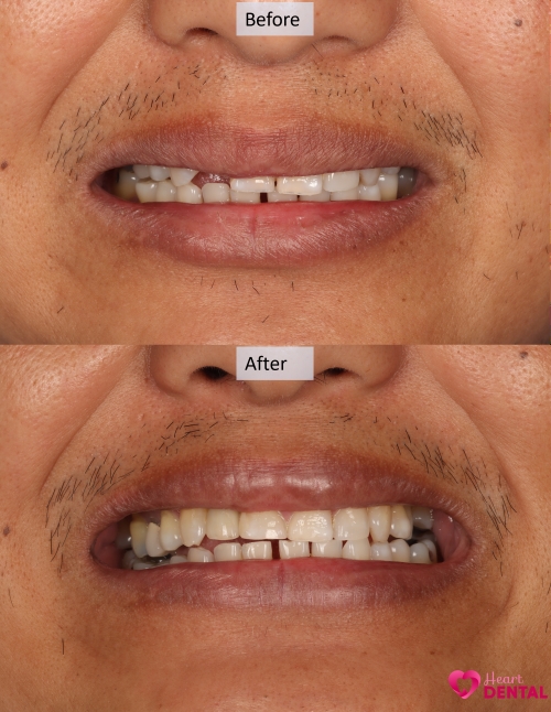 Dental implants for front tooth helps patient smile with confidence again. It was placed on the same day helping patient smile with confident again. Location: Carson, CA.