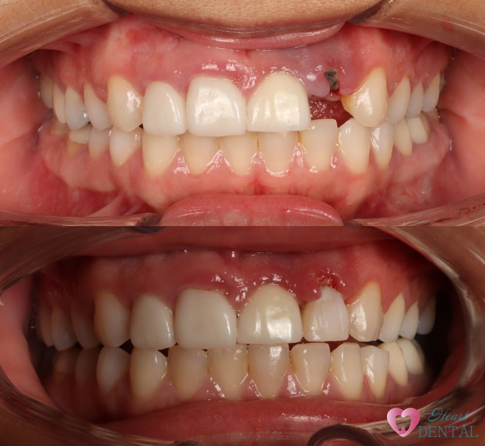 Immediate implant placement with temporary crown allows great gum healing