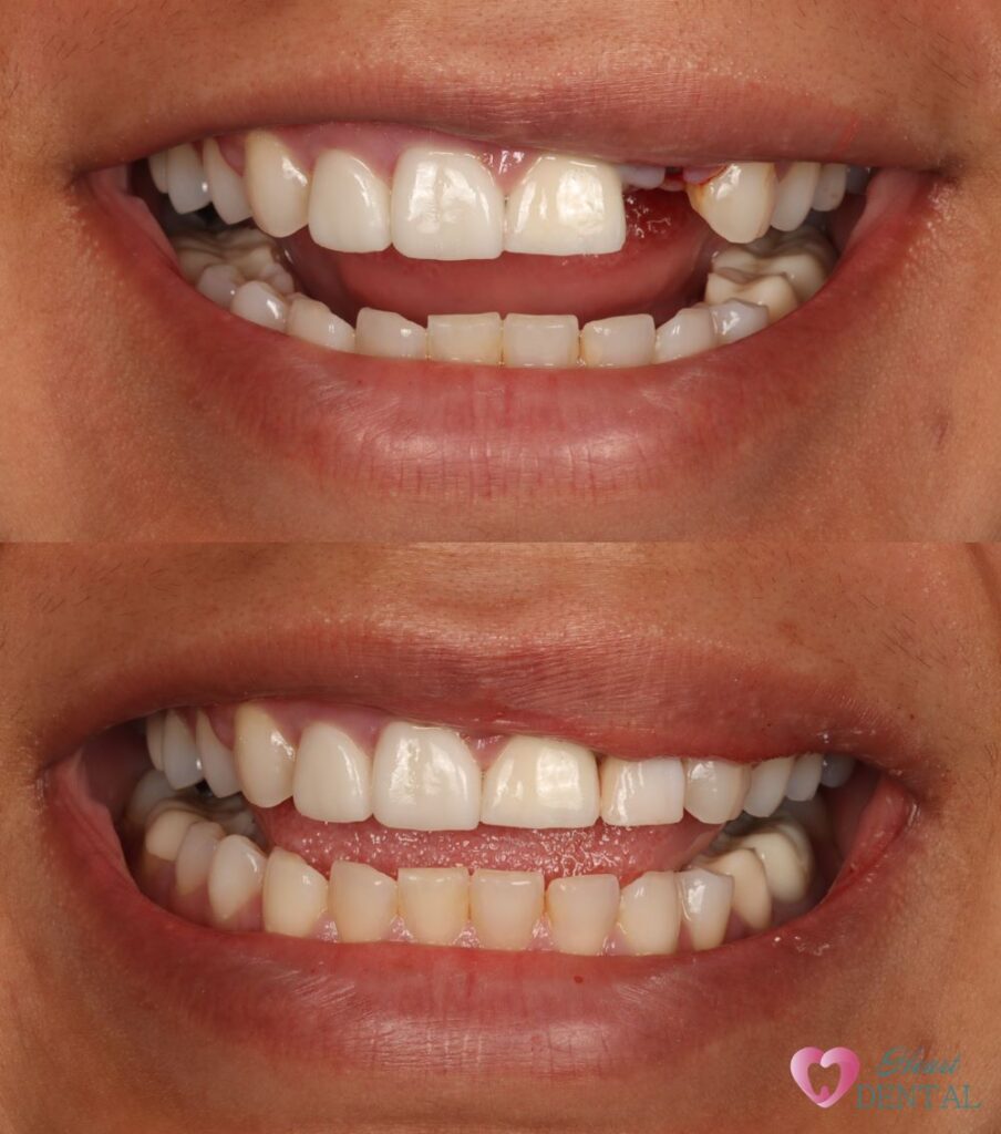 Immediate implant is a great service to patient with broken teeth