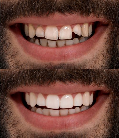 Beautiful result with orthodontic treatments in Carson.