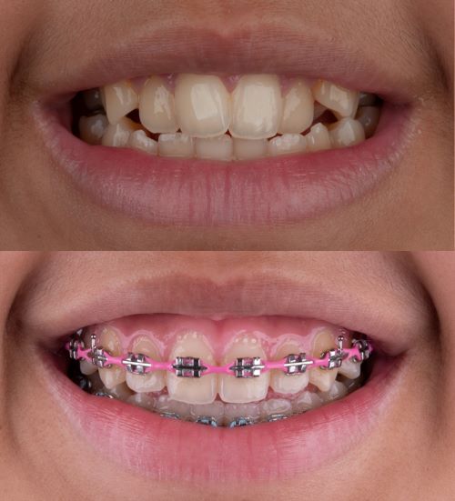 Before and after with braces in Carson.