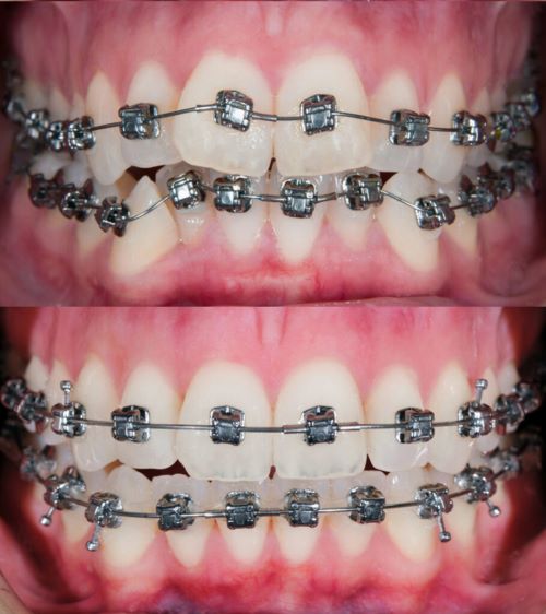 Orthodontic braces are a reliable way to straighten teeth and transform smiles.