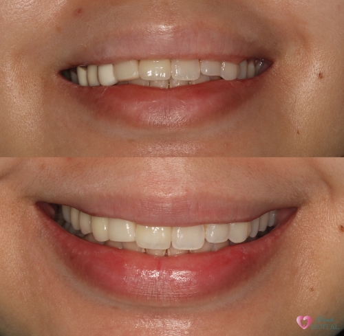 Our experienced dentist replaced the old broken dental bridge with  the new bridge that matched her natural teeth. Patient was happy with the result.