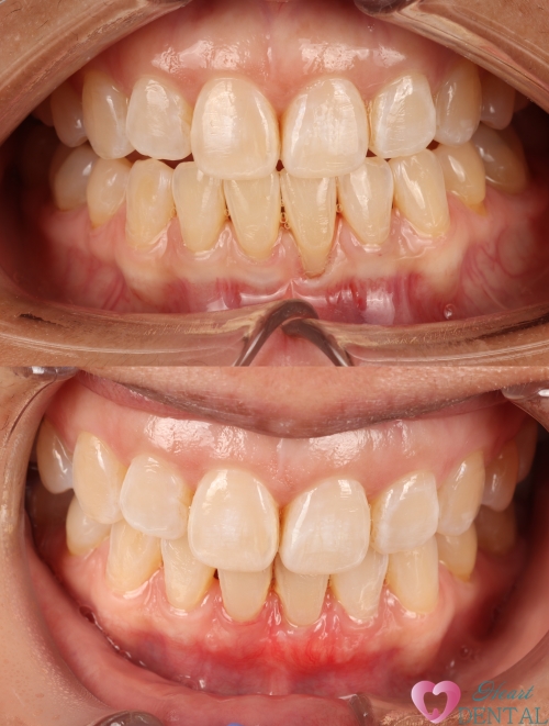 Gum grafting helps to cover root exposure and repair gum recession. Work done by Heart Dental, dentist in Carson, CA.