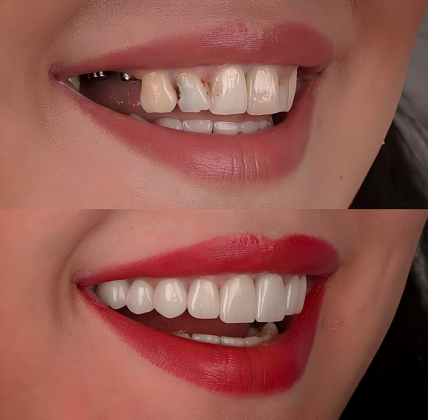 Dental implants transforms smile amazingly.