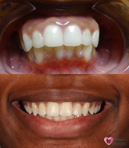 Orthodontist in Carson: braces for a adult patient created beautiful result.