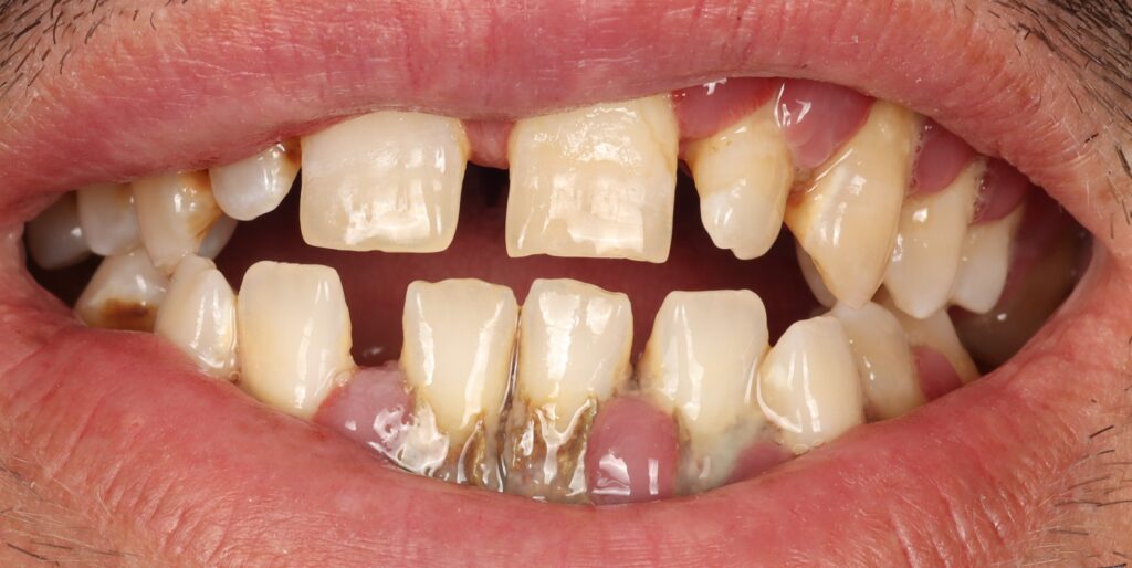 Gum disease can be shown with red and swollen gum.